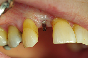 dental implants Salisbury